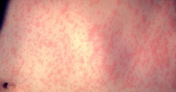 Wisconsin officials confirm first measles cases of the year