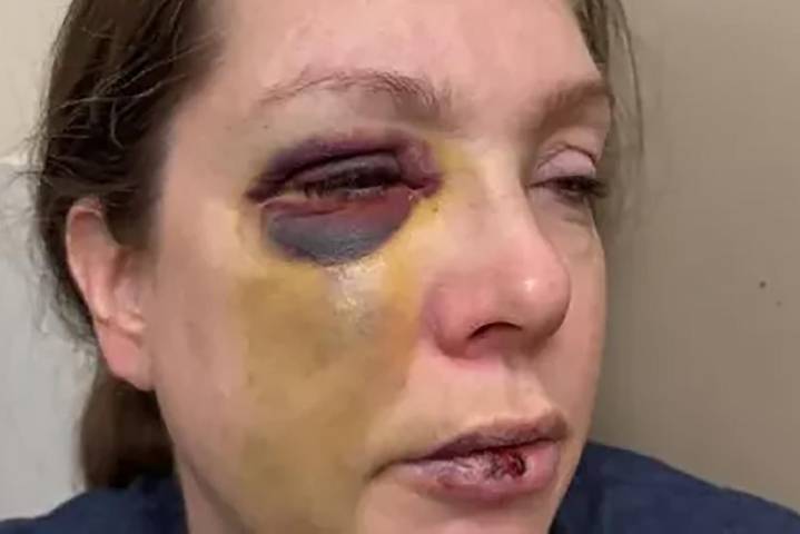 Cincinnati Beating Victim Breaks Silence, Reveals 'Very Bad Brain Trauma' After Viral Attack
