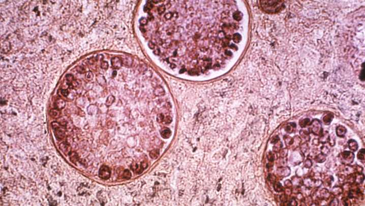 Valley Fever cases surge across California in 2025