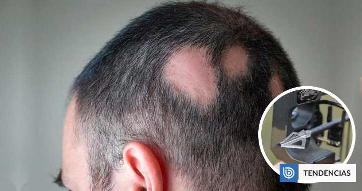 De milagro: hombre sobrevivió 2 días con una flecha de ballesta clavada en su cabeza en Italia
