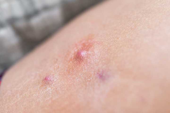 GLP-1 Medications Show Promise in Treating Hidradenitis Suppurativa