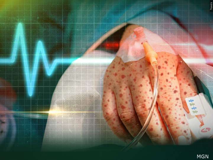 Measles outbreak is over in Texas, state health officials declare