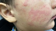 Measles outbreak in southwest Kansas is over