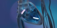 New pacemaker technology being offered at Aspirus St. Luke’s for Northlanders