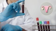Un análisis de sangre permitiría detectar el cáncer de ovario en sus primeras etapas, según investigación