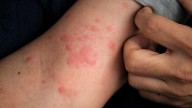 Stepwise Approach Recommended for Treating Sun Allergy