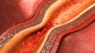Cholesterol Raises Heart Risks in Young Despite Clean Scans