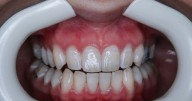 Cops: Floridian Posing as Veneer Tech Used 'Crazy Glue' on Clients' Teeth