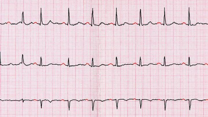 Evidence-Based Guidelines Issued for LAAO Devices