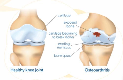 ‘It’s not an older person’s disease’: Experts combat arthritis myths for awareness month