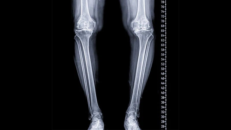 La osteotomía tibial alta podría retrasar la progresión de la osteoartritis de rodilla