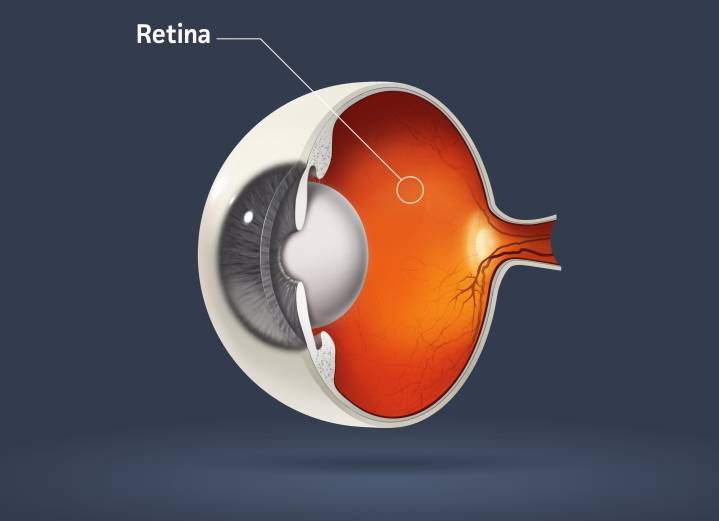 Rapid Fluid Resolution Associated With Longer Dosing Intervals of Eylea HD, Post