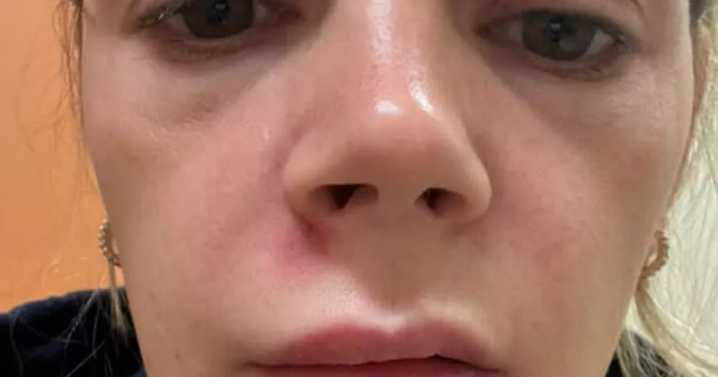 Mum hospitalised squeezing spot on 'triangle of death' area of face