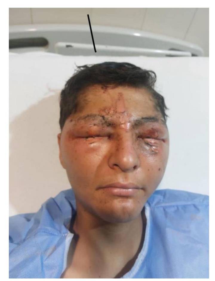 Joven pierde la vista debido a un proyecto escolar sin supervisar