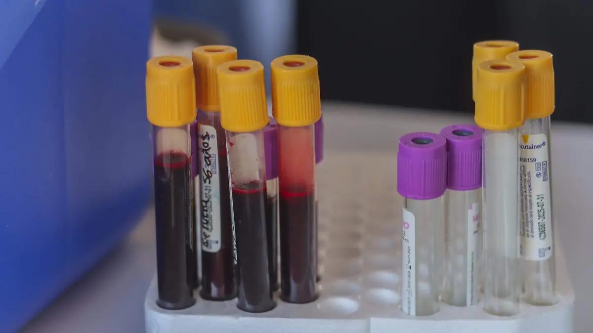 Mieloma Múltiple, un cáncer poco común