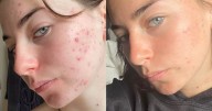 Spot-prone teens praise 'life changing' skincare products before term starts