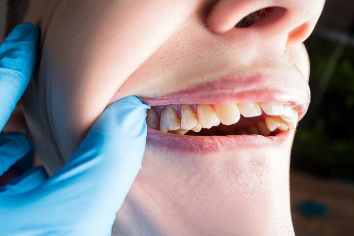 La alerta sanitaria por el uso de una pasta de dientes de la marca Colgate ya afecta a cinco países