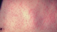 Possible measles exposure at Dulles International Airport under investigation