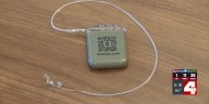 Device to treat epilepsy shows promise for stroke patients