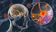 Dementia Follows a Different Course in Men