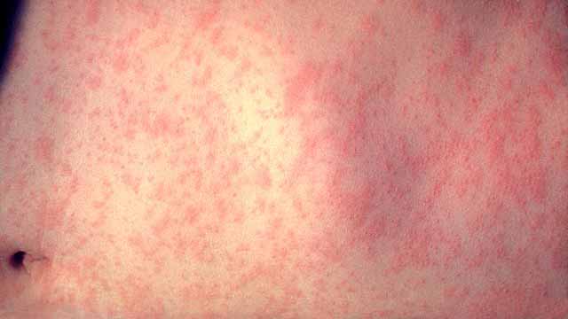 Teen contracts first measles case in San Diego County this year, exposes others at clinic, ER
