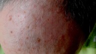 5-Fluorouracil 4% Cream Effective for Hyperkeratotic AKs