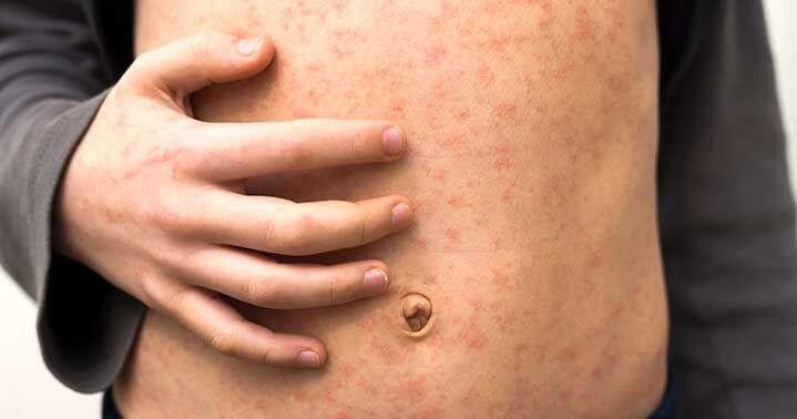 There are still 11 Utah residents diagnosed with measles
