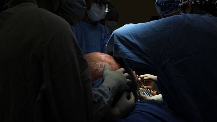 IMSS de Querétaro extirpa tumor ovárico de casi 23 kilogramos a paciente de 37 años (Video)