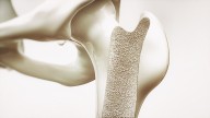 Skipping Breakfast, Eating Late May Increase Osteoporosis Risk