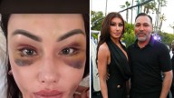 Holly Sonders Shows Gnarly Bruises After Filler Removal