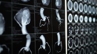 Routine Coronary Function Testing May Improve Angina Care