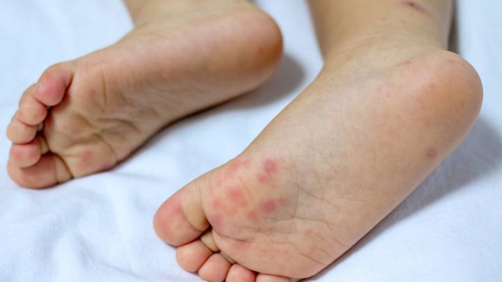 The highly contagious summer illness parents of young kids need to know about