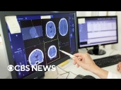 New study finds link between traumatic brain injuries and brain cancer risk
