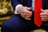 Trump tries — and fails — to hide bruises on his hands