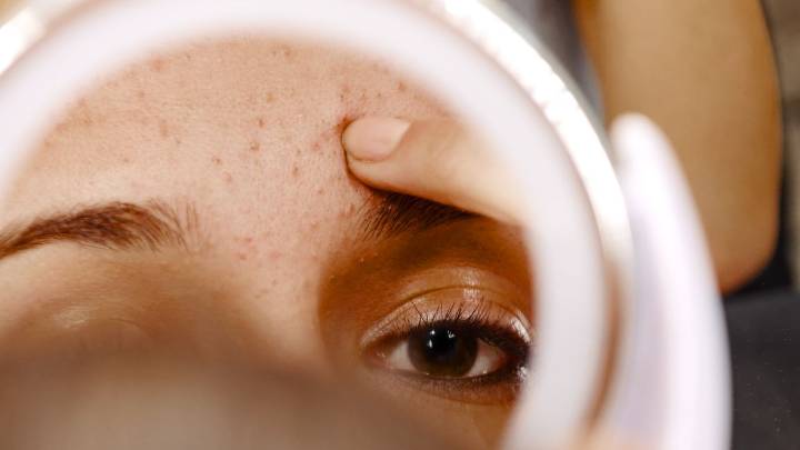 It’s Not a Whitehead, It’s Milia—Here's How to Treat It
