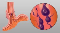 Prophylactic Antibiotics May Be of No Use in Cirrhosis With Upper GI Bleeding