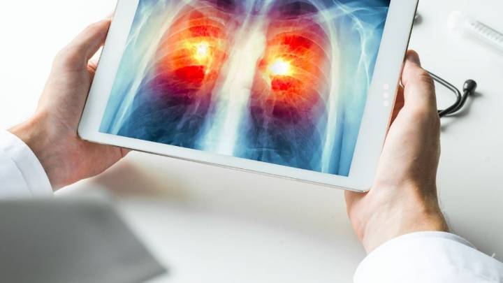 Estos son los alimentos que podrían aumentar el riesgo de sufrir cáncer de pulmón