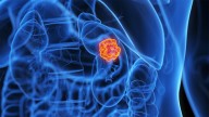 Drug Combo Shows Benefits in Rare, Aggressive Kidney Cancer