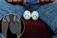 Tumor the size of a chicken egg found in man's scrotum