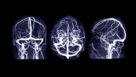 Prenatal Exposure to Pesticide Chlorpyrifos Linked to Brain Abnormalities