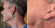 Gordon Ramsay muestra su cicatriz tras operarse por un cáncer de piel