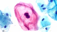 A Third Of Americans Are Unaware Of HPV; No Wonder Vaccination Rates Are Dangerously Low