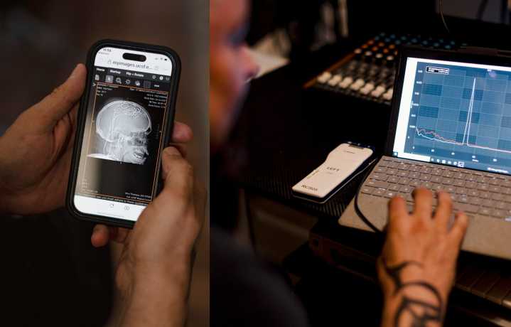 Intentan aliviar el dolor crónico con estimulación cerebral personalizada