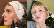Skinvive Review: I Tried the Injectable Filler