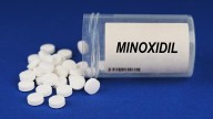 Oral Minoxidil For Hair Loss Not Linked to Tachycardia