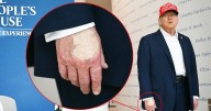 Trump, 79, Smears Right Hand In Makeup Amid Cankles Cover