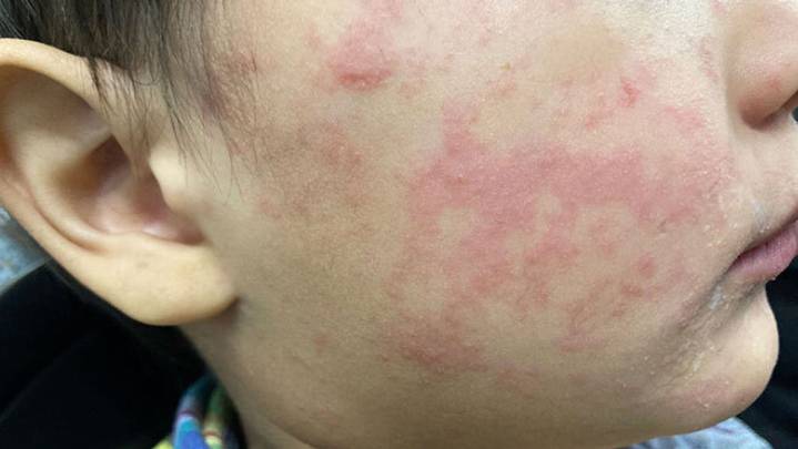 Measles outbreak in southwest Kansas is over
