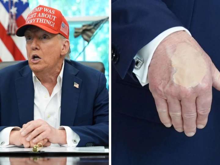 ¿Qué le pasa a Donald Trump? Los moretones en sus manos preocupan a Estados Unidos