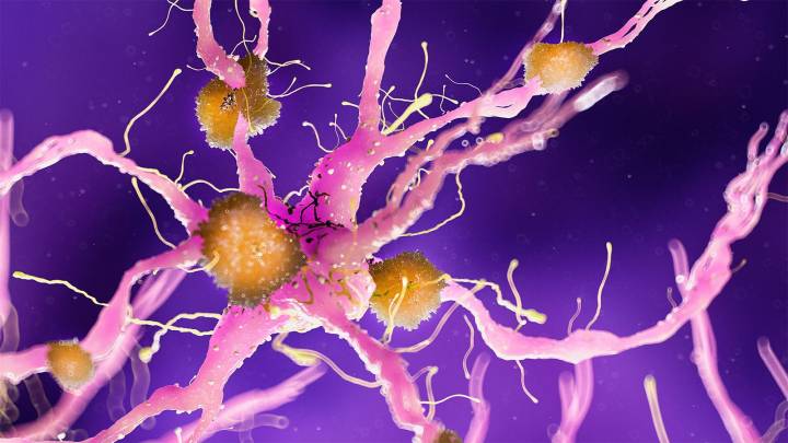 Lithium May Combat Alzheimer's Disease, Data Suggest