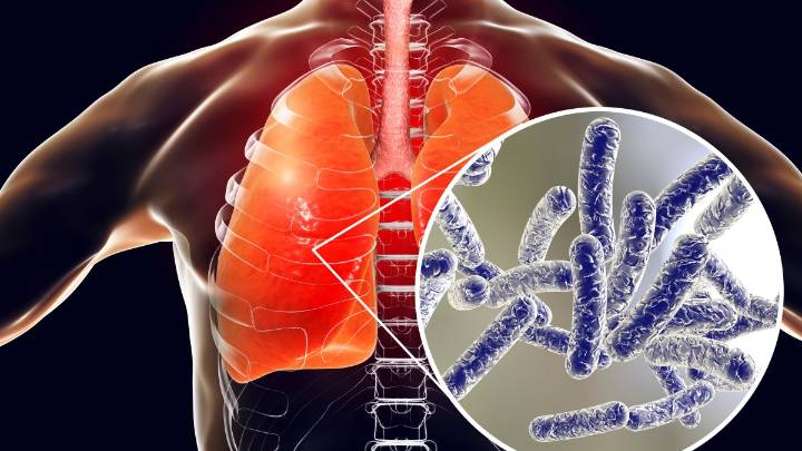 What to know about Legionnaires' disease as third person dies in NYC outbreak